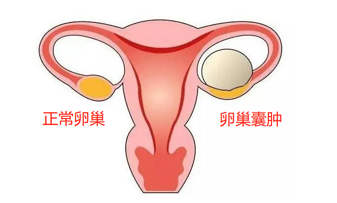 西安生殖保健院王艳丽治疗不孕症：卵巢囊肿会疼吗?有哪些症状?