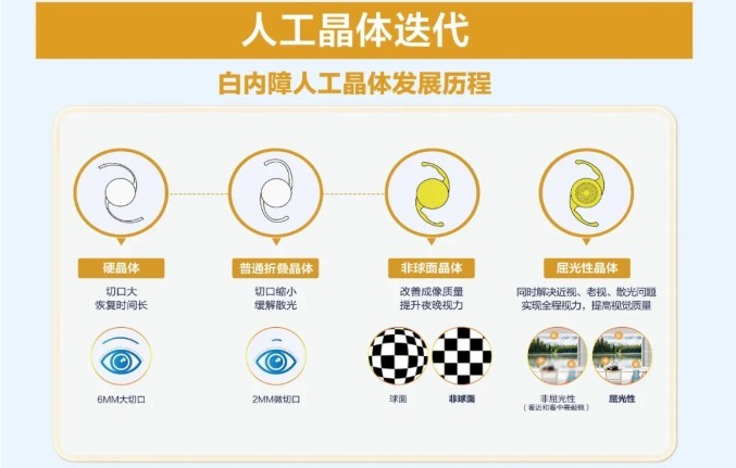 上海眼科院长：近视度数超过了白内障人工晶体矫正范围怎么办？