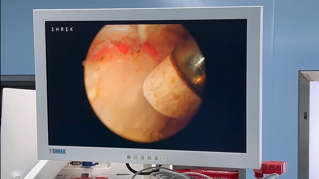 强直髋关节镜技术——毫米可视微创解决髋部大问题