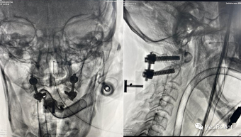 颈椎手术里程碑！美敦力Mazor X??领跑未来