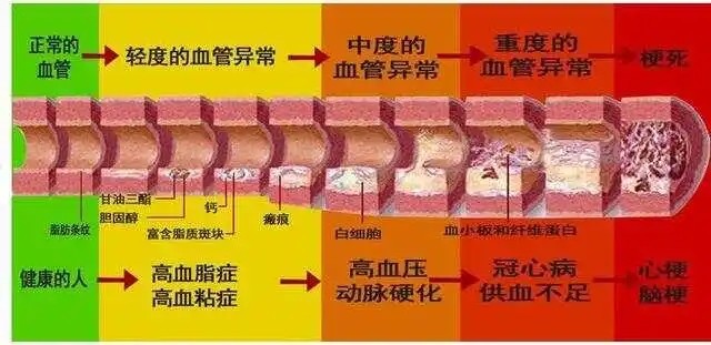 调理血脂对预防心脑血管疾病的重要性