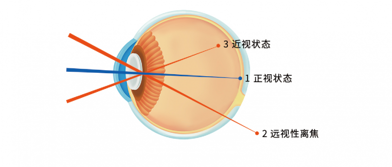 铂林眼科双镜视控解决方案--铂视控系列离焦镜片